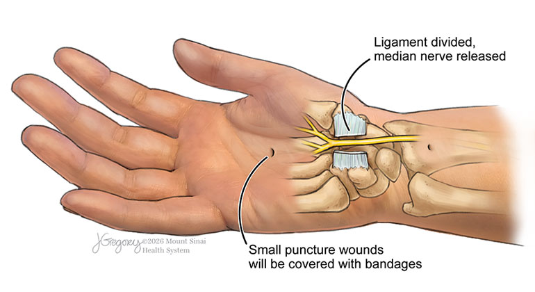 carpal tunnel illustration
